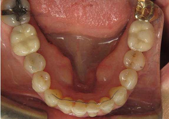 after-md-occlusal-5