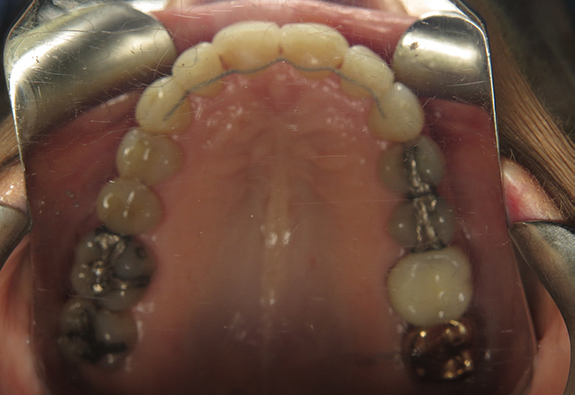 after-mx-occlusal-8