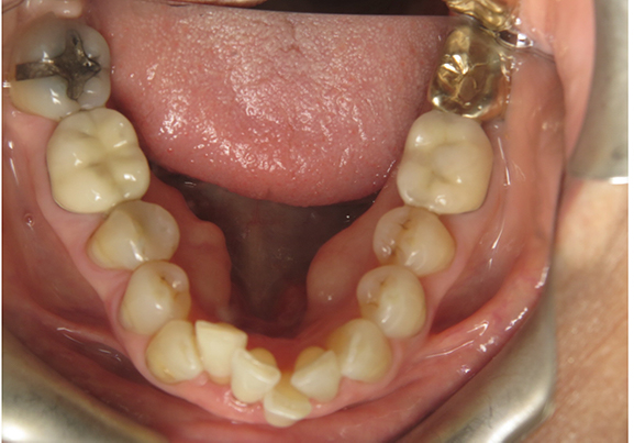before-md-occlusal-6