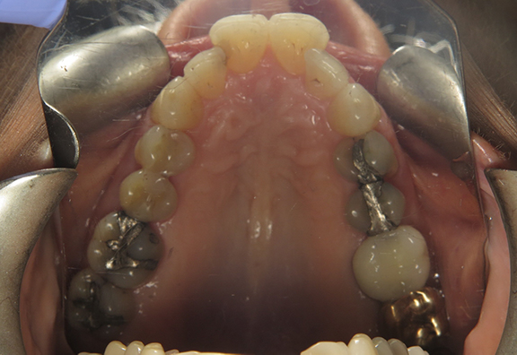 before-mx-occlusal-7