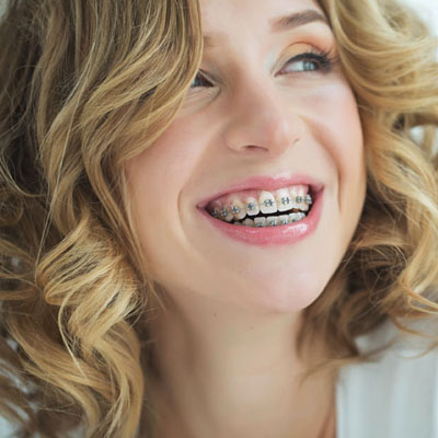 Have a beautiful smile with braces in Westlake village.